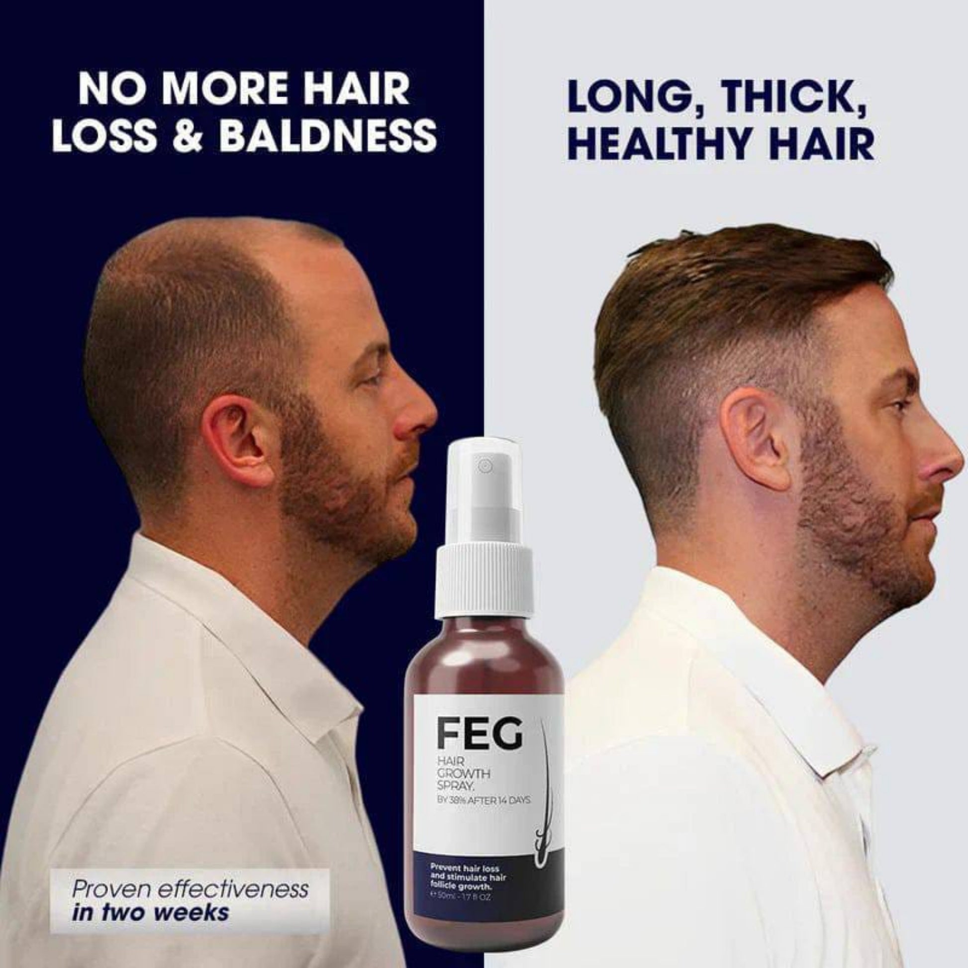 FEG Plus Hair Regrowth Spray bald to hair growth transformation